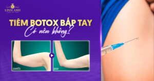 Tiêm botox bắp tay