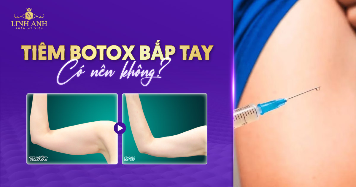 Tiêm botox bắp tay có nên không? Bao lâu có hiệu quả