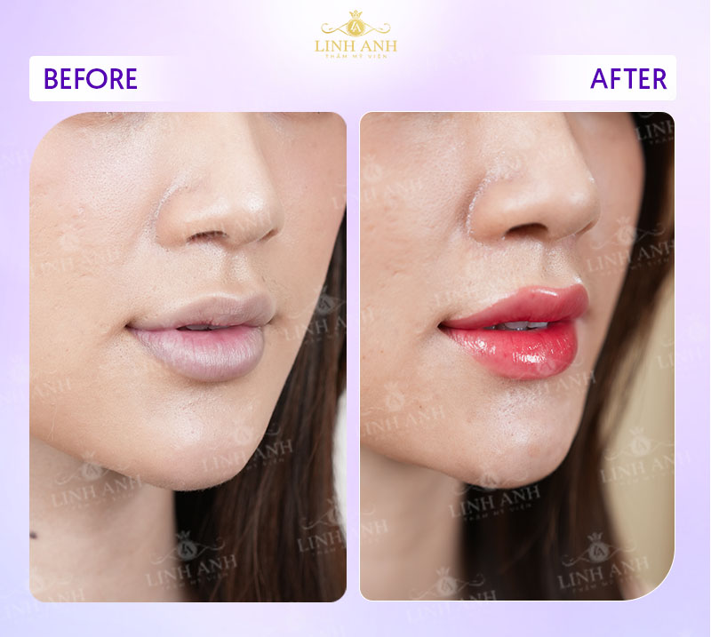 tổng hợp hình ảnh phun môi tổng hợp hình ảnh phun môi