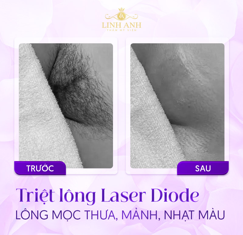 Triệt lông bikini an toàn tại Linh Anh