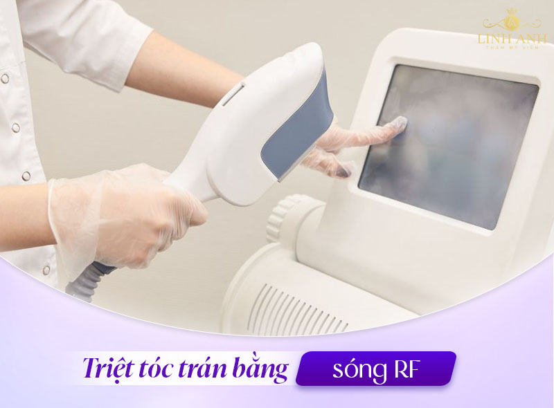 Triệt tóc mai vùng trán Triệt tóc mai vùng trán