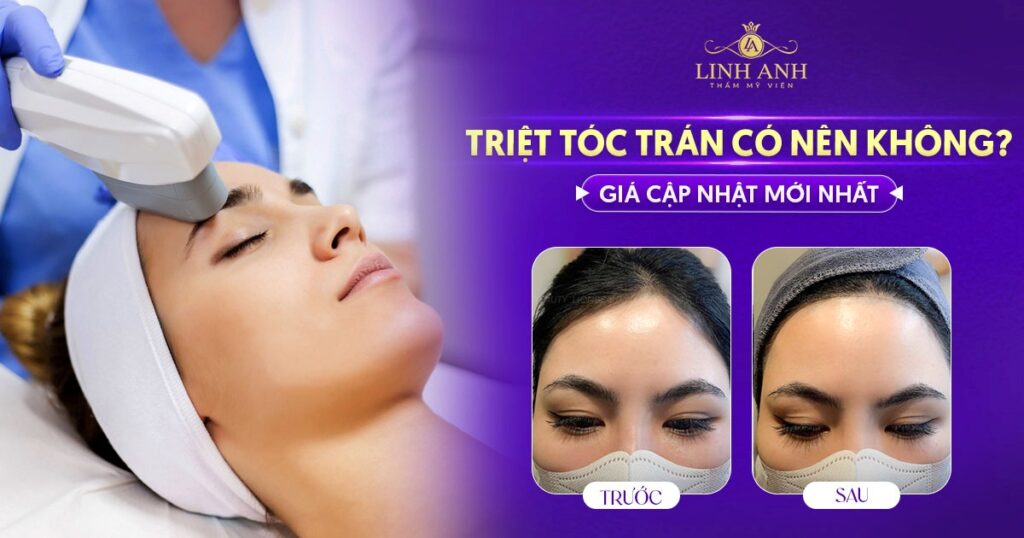 Triệt tóc trán