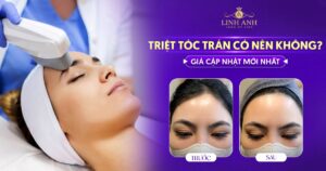 Triệt tóc trán
