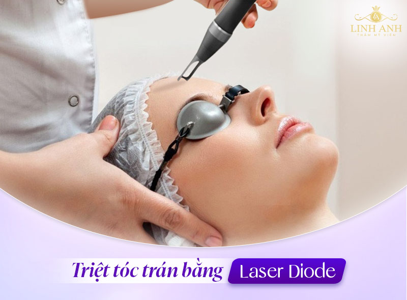 Triệt tóc trán diode laser Triệt tóc trán diode laser
