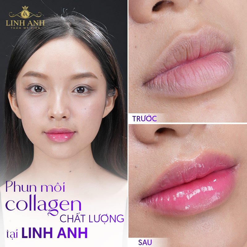 ưu nhược điểm khi xăm môi collagen ưu nhược điểm khi xăm môi collagen