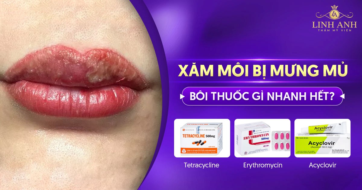 xăm môi bị mưng mủ bôi thuốc gì