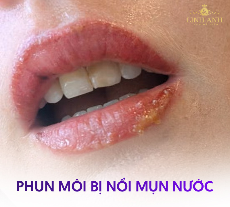 xăm môi hỏng sẽ ra sao