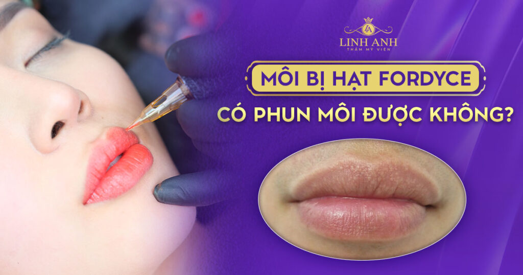 môi bị hạt fordyce có phun môi được không