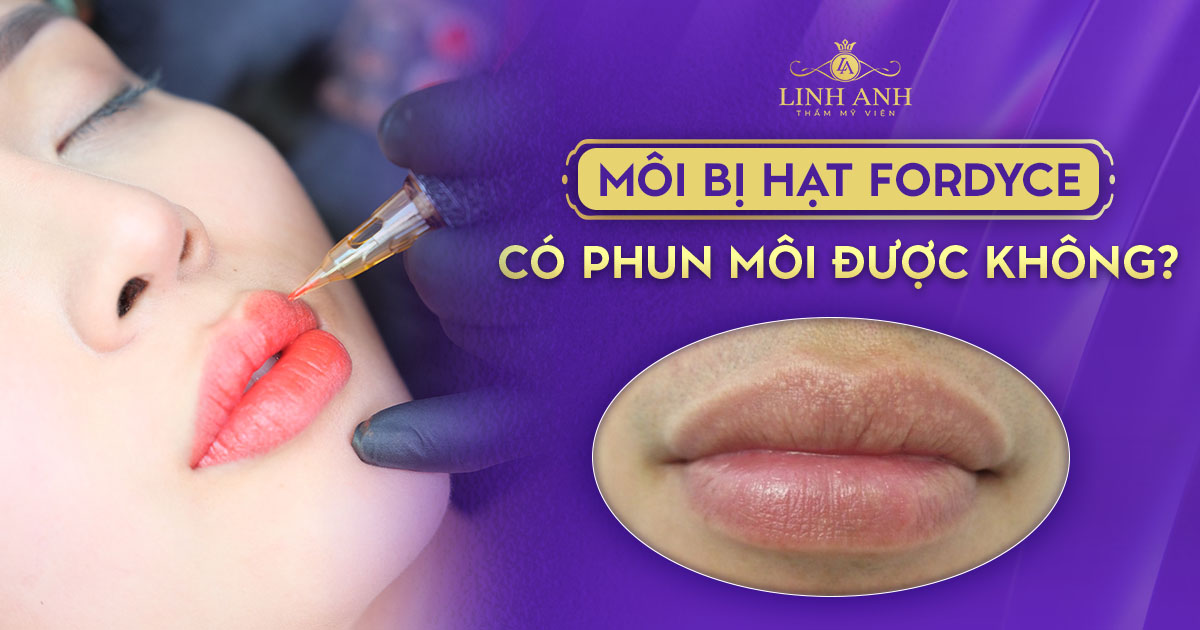 Môi bị hạt fordyce có phun môi được không? [Góc giải đáp]