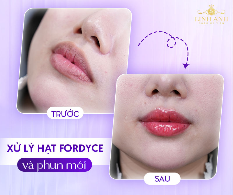 môi bị hạt fordyce xăm có ảnh hưởng gì không