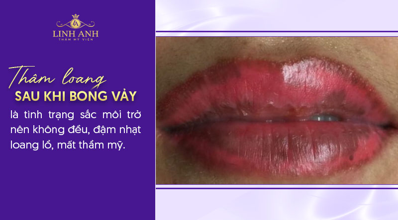 môi bị thâm loang sau khi bong môi bị thâm loang sau khi bong