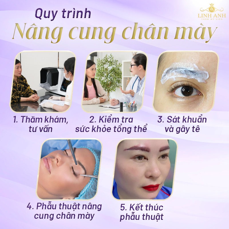 nâng cung chân mày bằng chỉ nâng cung chân mày bằng chỉ
