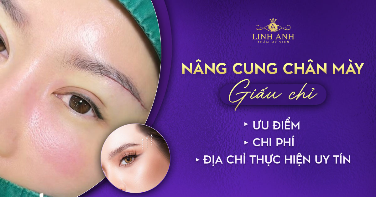 Nâng cung chân mày giấu chỉ: Ưu điểm, chi phí và địa chỉ thực hiện uy tín