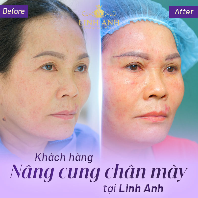 nâng cung mày giấu chỉ có hiệu quả không nâng cung mày giấu chỉ có hiệu quả không