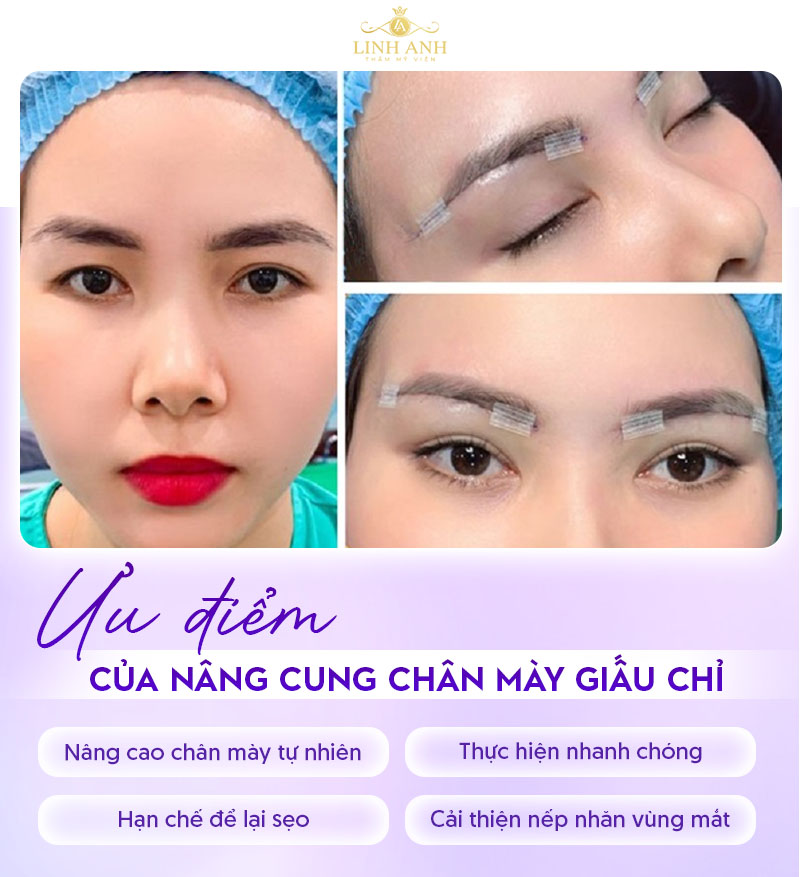 nâng cung mày giấu chỉ nâng cung mày giấu chỉ