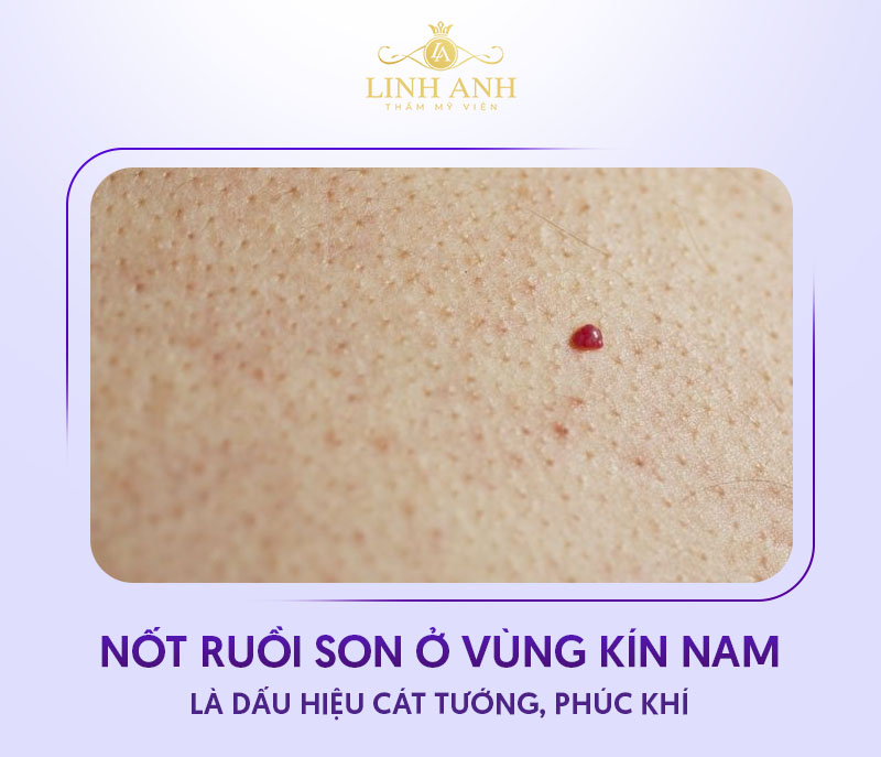 Nốt ruồi son vùng kín nam Nốt ruồi son vùng kín nam