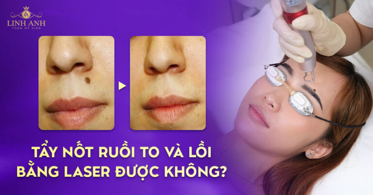 Tẩy nốt ruồi to và lồi bằng laser được không? Phương pháp an toàn