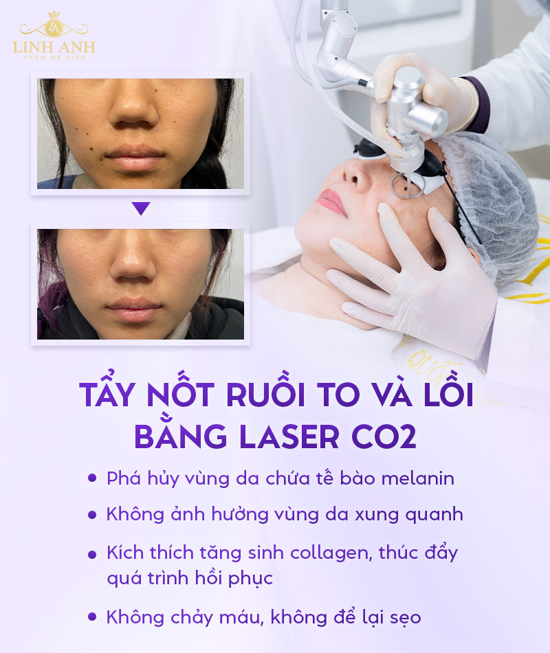 Tẩy nốt ruồi to và lồi bằng Laser CO2