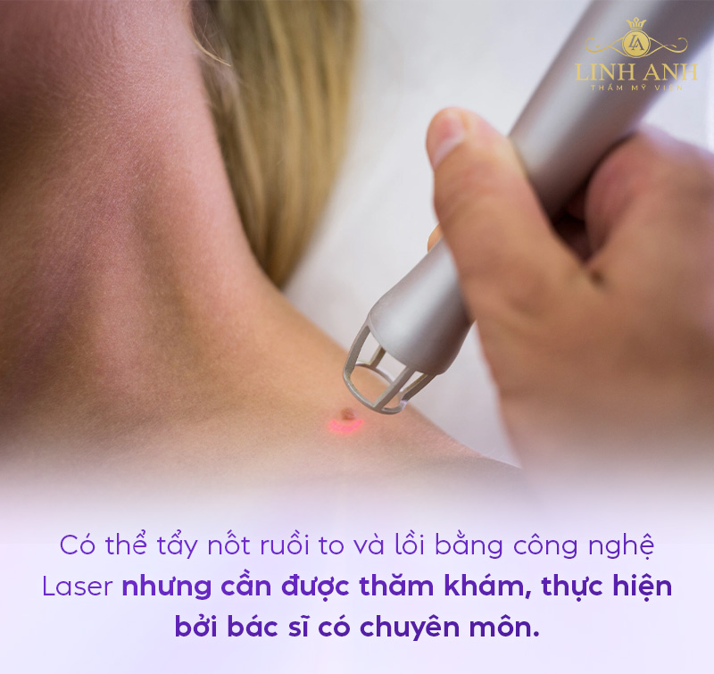 Tẩy nốt ruồi to và lồi bằng laser được không