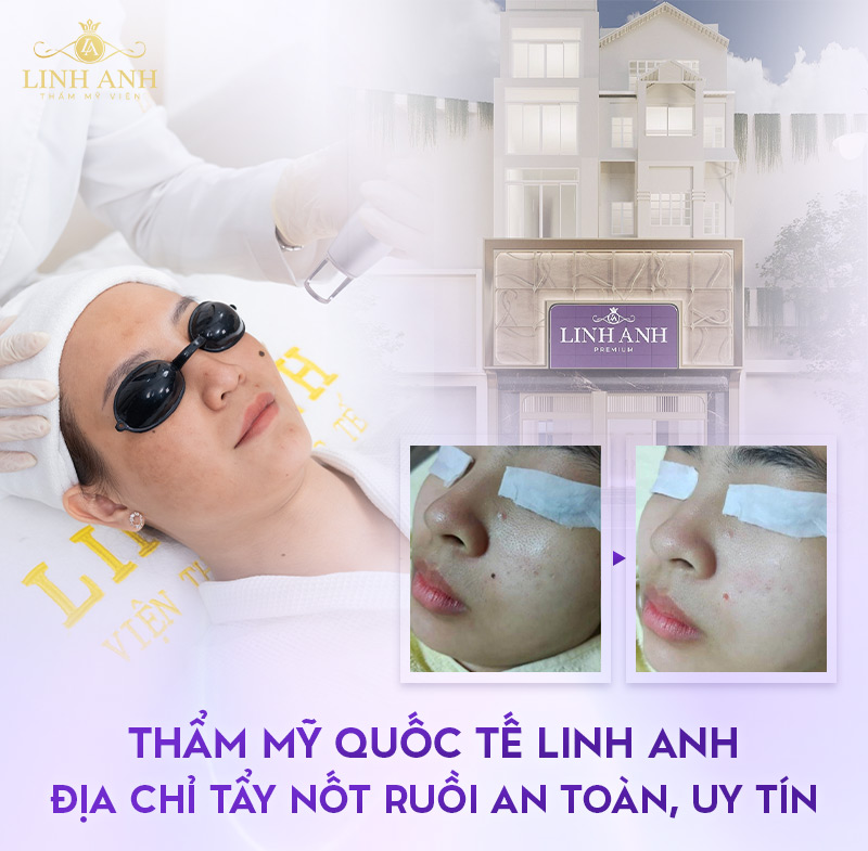 Tẩy nốt ruồi to và lồi ở đâu