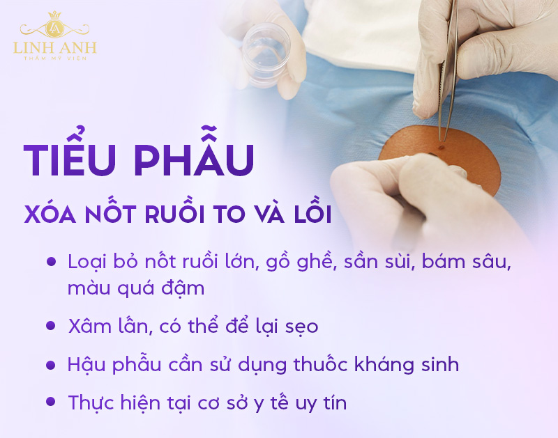 Tiểu phẫu xóa nốt ruồi to và lồi