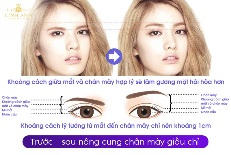 treo cung mày bằng chỉ treo cung mày bằng chỉ
