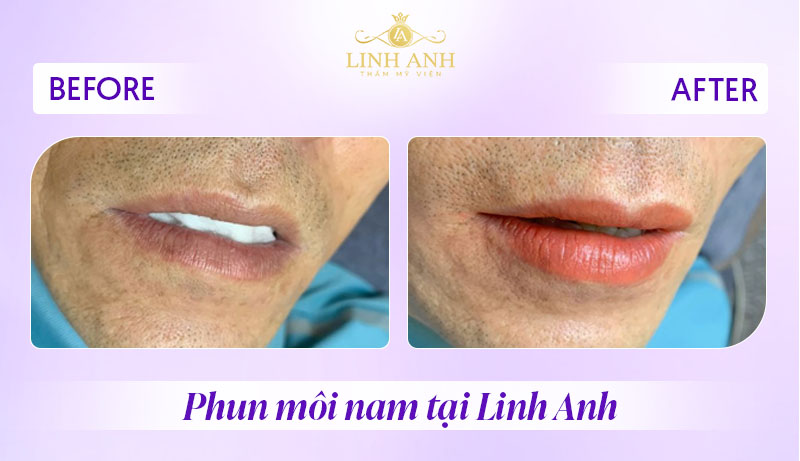 xăm môi cho nam tại Linh Anh xăm môi cho nam tại Linh Anh