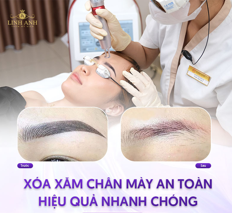 xóa phun mày có thể gây đổi màu da không xóa phun mày có thể gây đổi màu da không