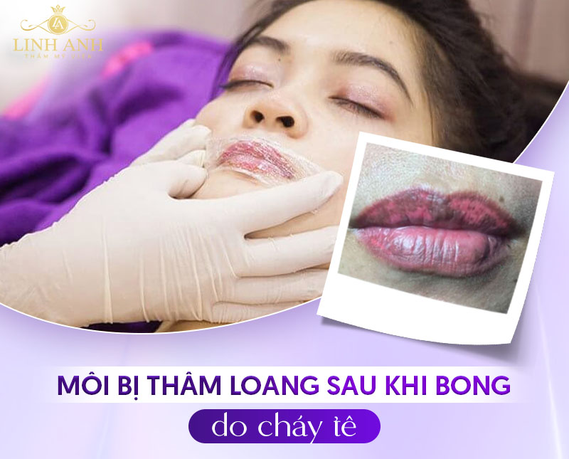 xử lý môi bị thâm loang tình trạng nhẹ xử lý môi bị thâm loang tình trạng nhẹ