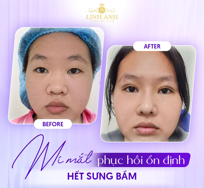 1 tháng sau khi cắt mí mắt sẽ ra sao 1 tháng sau khi cắt mí mắt sẽ ra sao