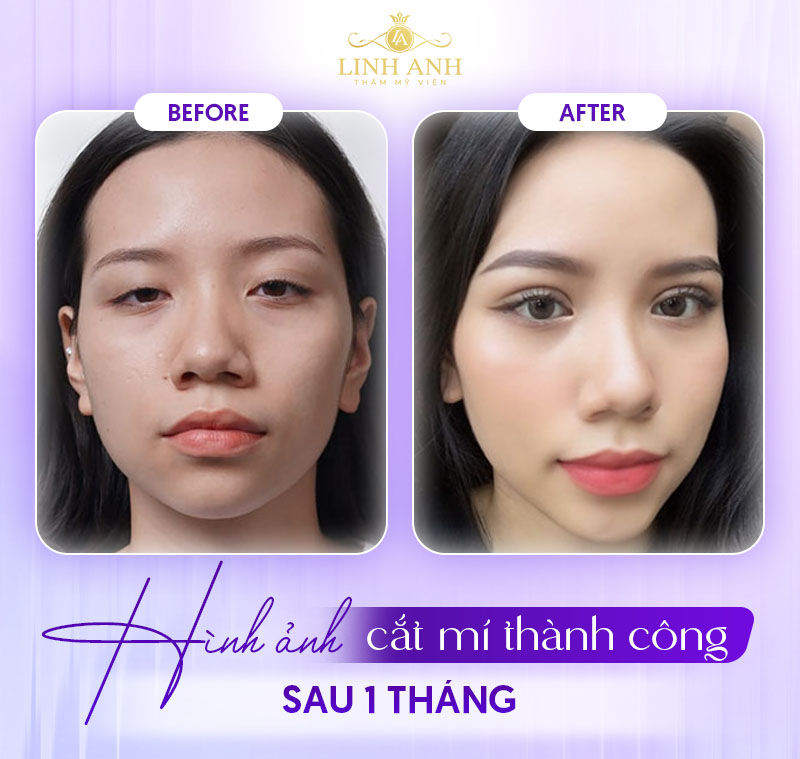 1 tháng sau khi cắt mí sẽ ra sao 1 tháng sau khi cắt mí sẽ ra sao