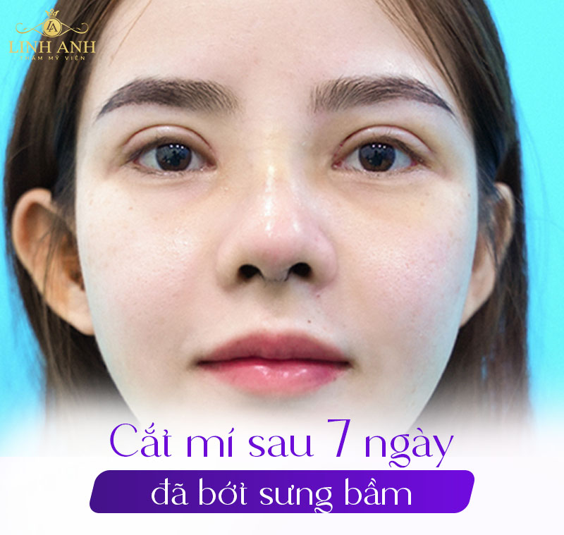7 ngày sau cắt mí sẽ như thế nào 7 ngày sau cắt mí sẽ như thế nào