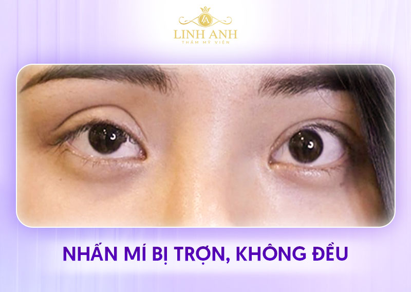 ảnh cắt mí sau 1 tháng thực tế ảnh cắt mí sau 1 tháng thực tế