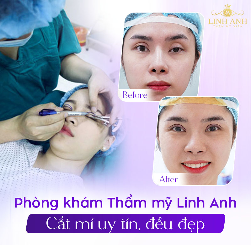ảnh cắt mí sau 7 ngày thực tế ảnh cắt mí sau 7 ngày thực tế