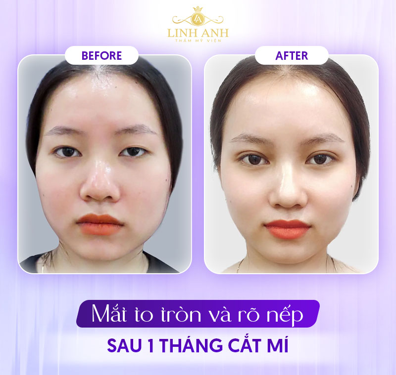 ảnh khách hàng cắt mí 1 tháng ảnh khách hàng cắt mí 1 tháng