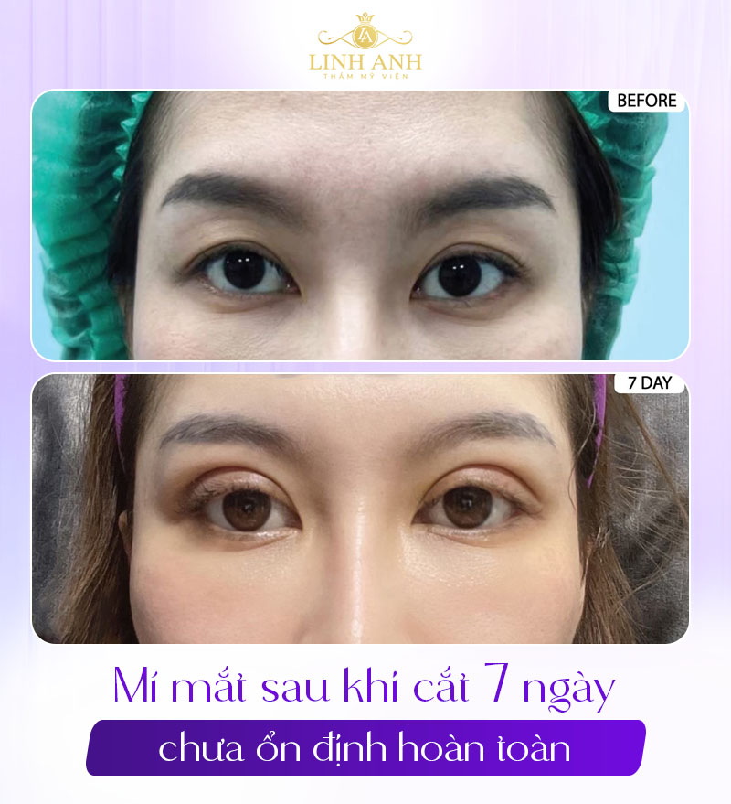 ảnh khách hàng cắt mí 7 ngày ảnh khách hàng cắt mí 7 ngày