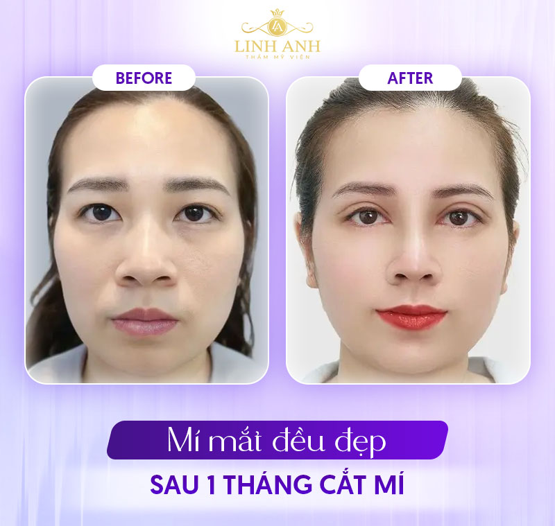 ảnh thực tế cắt mí 1 tháng từ khách hàng ảnh thực tế cắt mí 1 tháng từ khách hàng