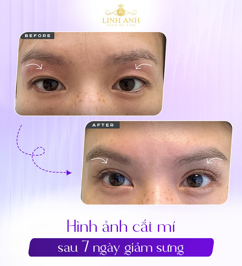 ảnh thực tế cắt mí 7 ngày từ khách hàng ảnh thực tế cắt mí 7 ngày từ khách hàng