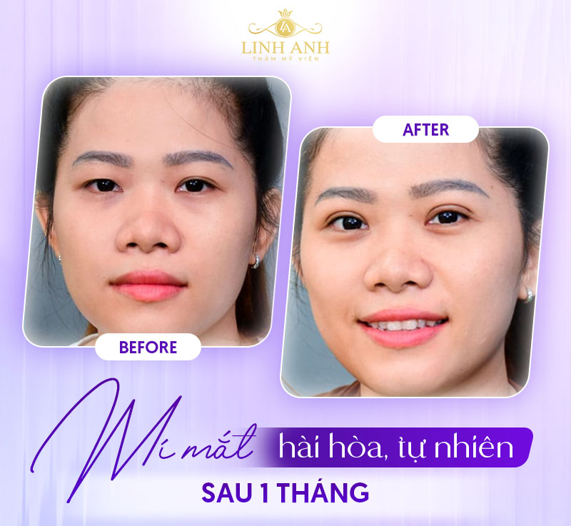 ảnh thực tế cắt mí mắt sau 1 tháng ảnh thực tế cắt mí mắt sau 1 tháng