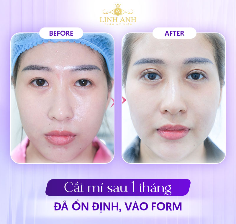 ảnh thực tế cắt mí sau 1 tháng ảnh thực tế cắt mí sau 1 tháng