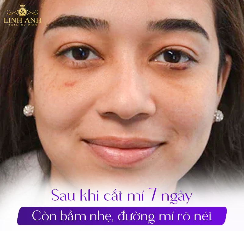 ảnh thực tế cắt mí sau 7 ngày ảnh thực tế cắt mí sau 7 ngày