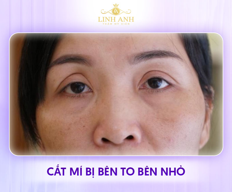 ảnh thực tế cắt mí mắt sau khoảng 1 tháng ảnh thực tế cắt mí mắt sau khoảng 1 tháng