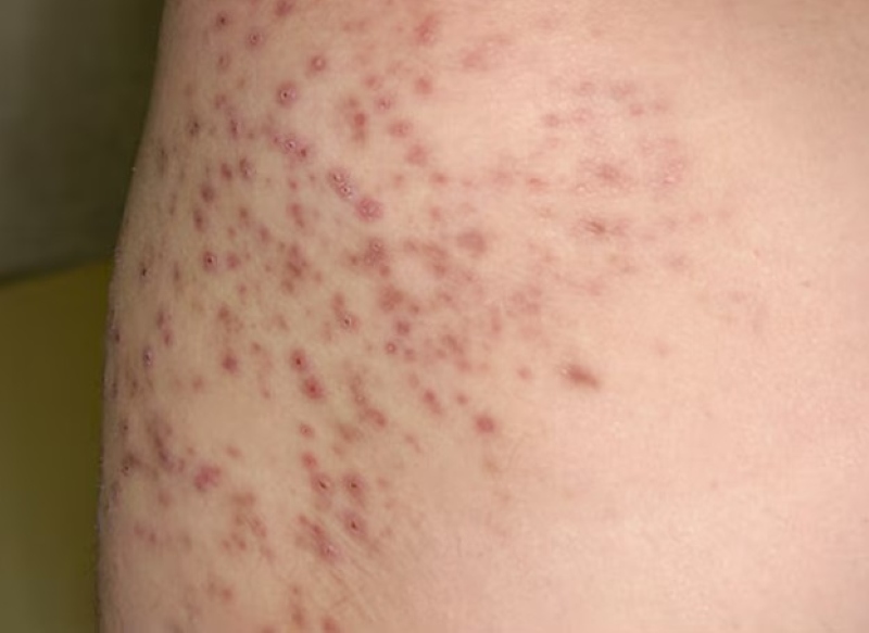 ảnh viêm lỗ chân lông ở vùng kín ảnh viêm lỗ chân lông ở vùng kín