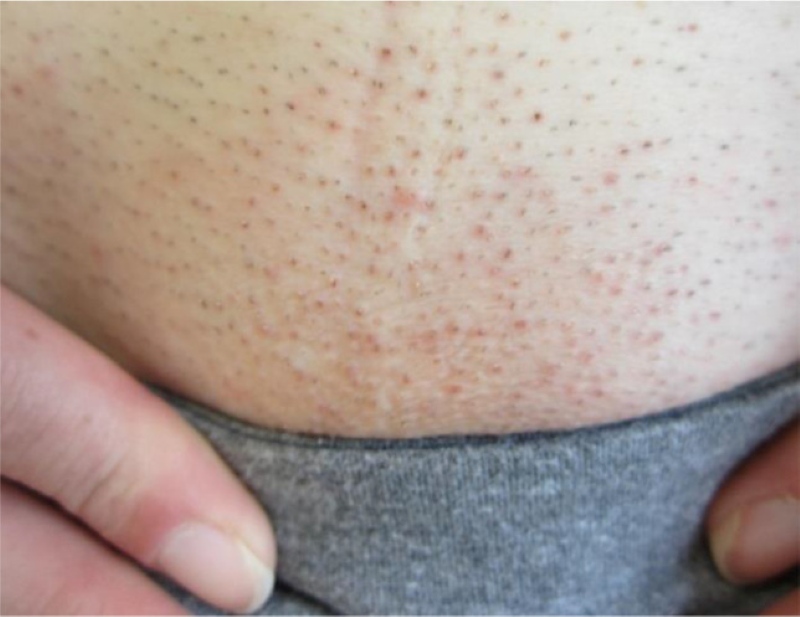 ảnh viêm nang lông bikini ở nữ ảnh viêm nang lông bikini ở nữ