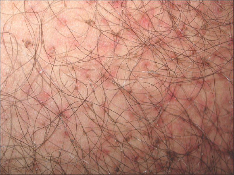 ảnh viêm nang lông vùng kín ở nữ ảnh viêm nang lông vùng kín ở nữ