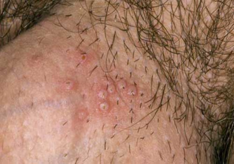 ảnh viêm nang lông vùng kín ảnh viêm nang lông vùng kín