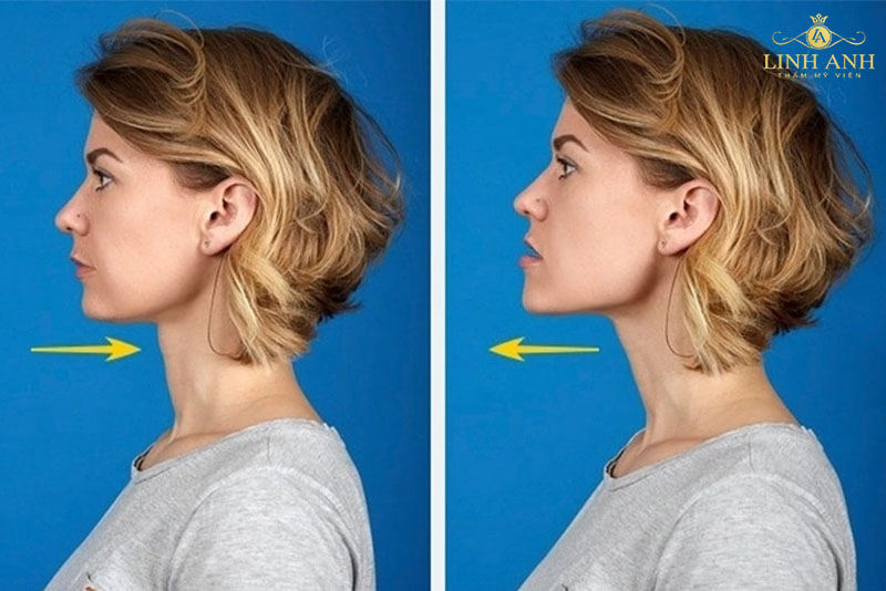 Các bài tập giảm mỡ nọng cằm Các bài tập giảm mỡ nọng cằm