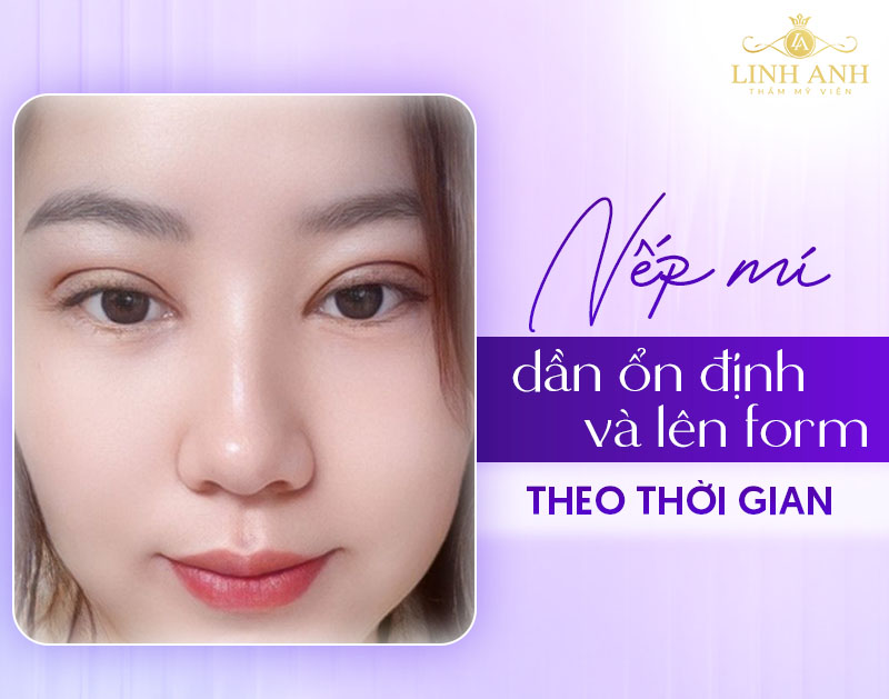 cắt mí mắt sau 1 tháng sẽ như thế nào cắt mí mắt sau 1 tháng sẽ như thế nào