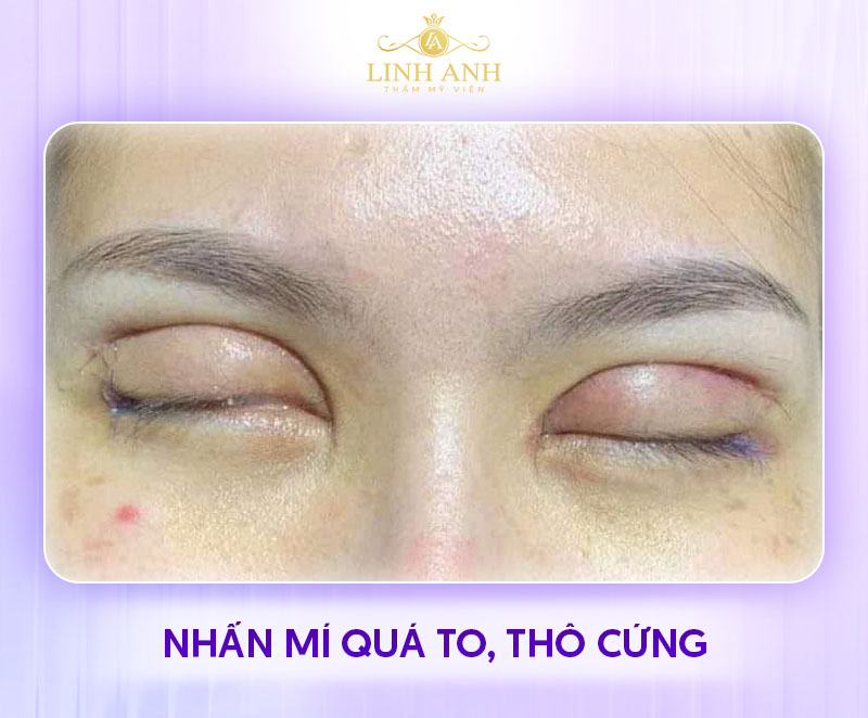 cắt mí mắt sau 1 tháng cắt mí mắt sau 1 tháng