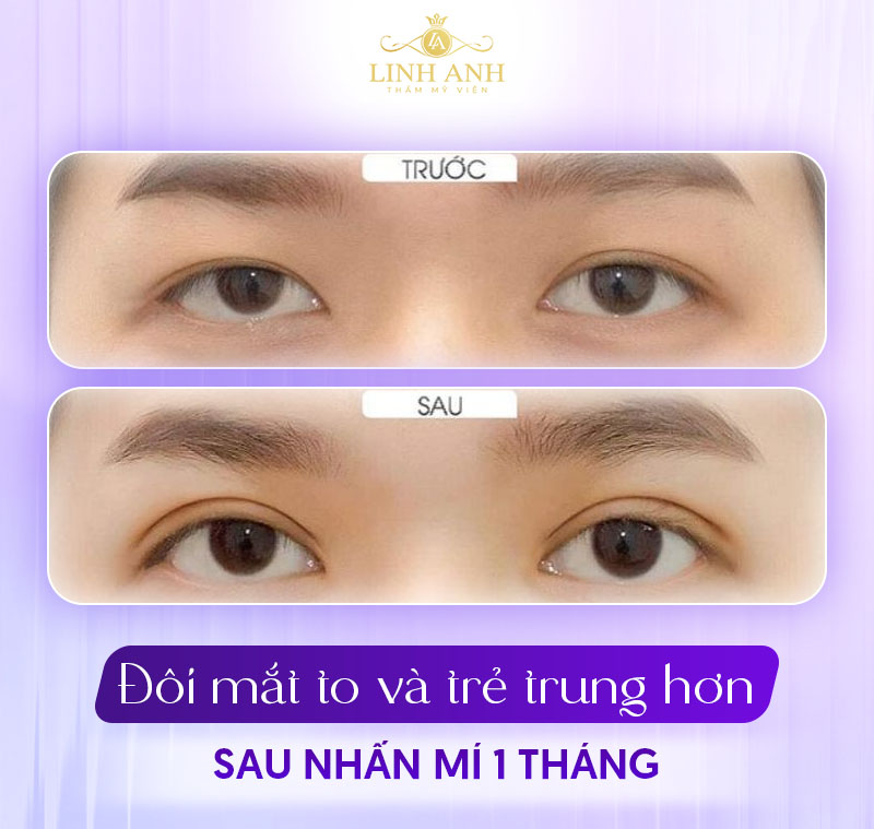 cắt mí sau 1 tháng sẽ như thế nào cắt mí sau 1 tháng sẽ như thế nào